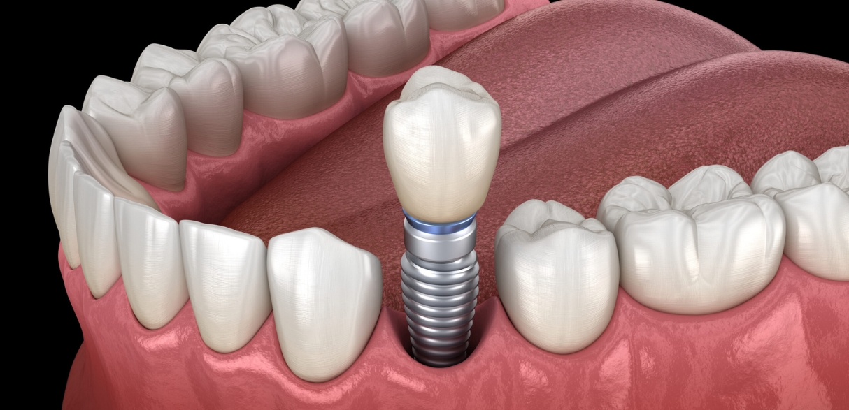 Can Dental Implants Improve Your Face Shape